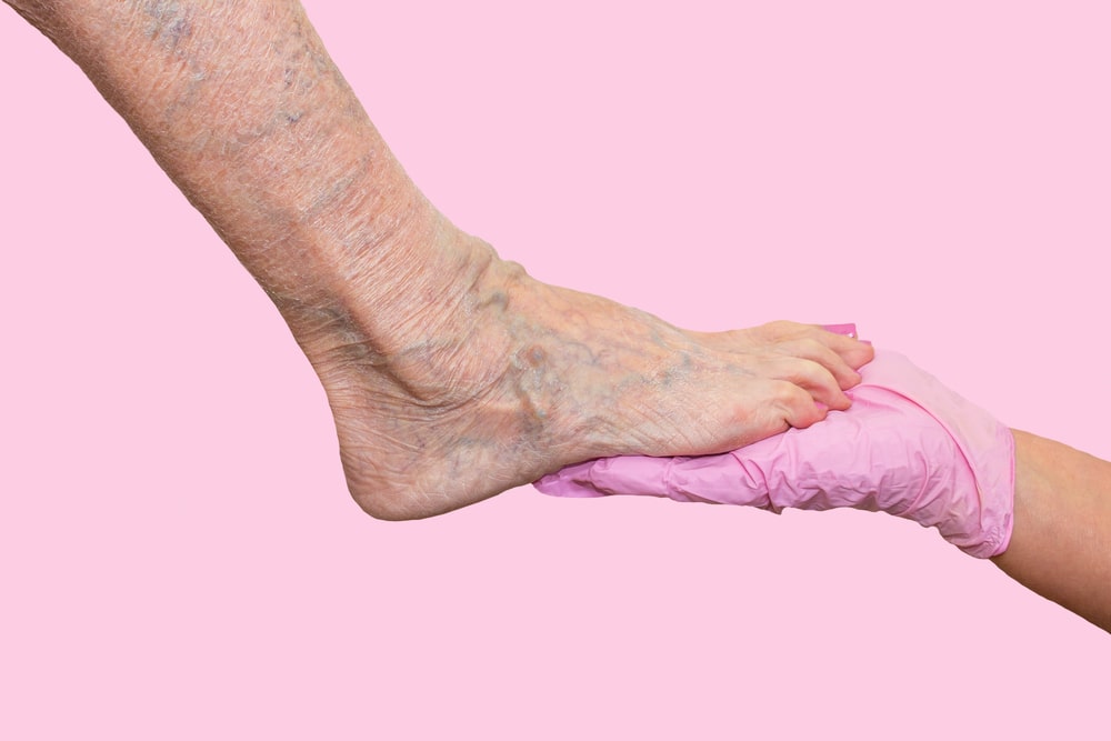 What is Chronic Venous Insufficiency?