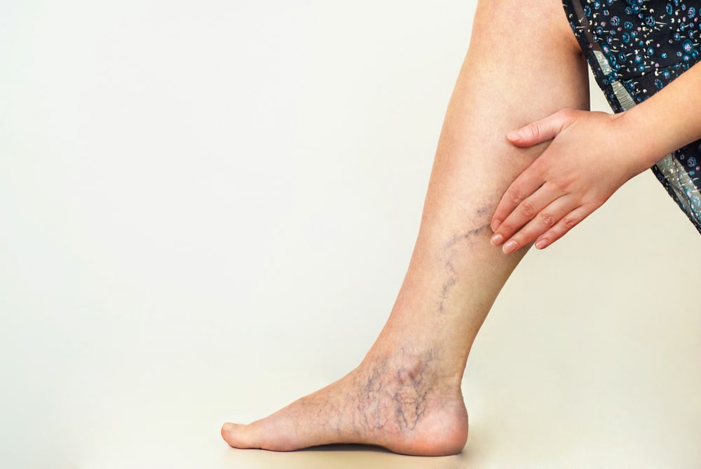 Ankle Discoloration – What is Stasis Dermatitis? - Veins Charlotte Blog:  Vascular Solutions: Vein Specialists