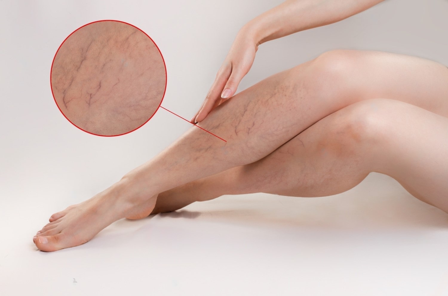 Ankle Discoloration – What is Stasis Dermatitis? - Veins Charlotte