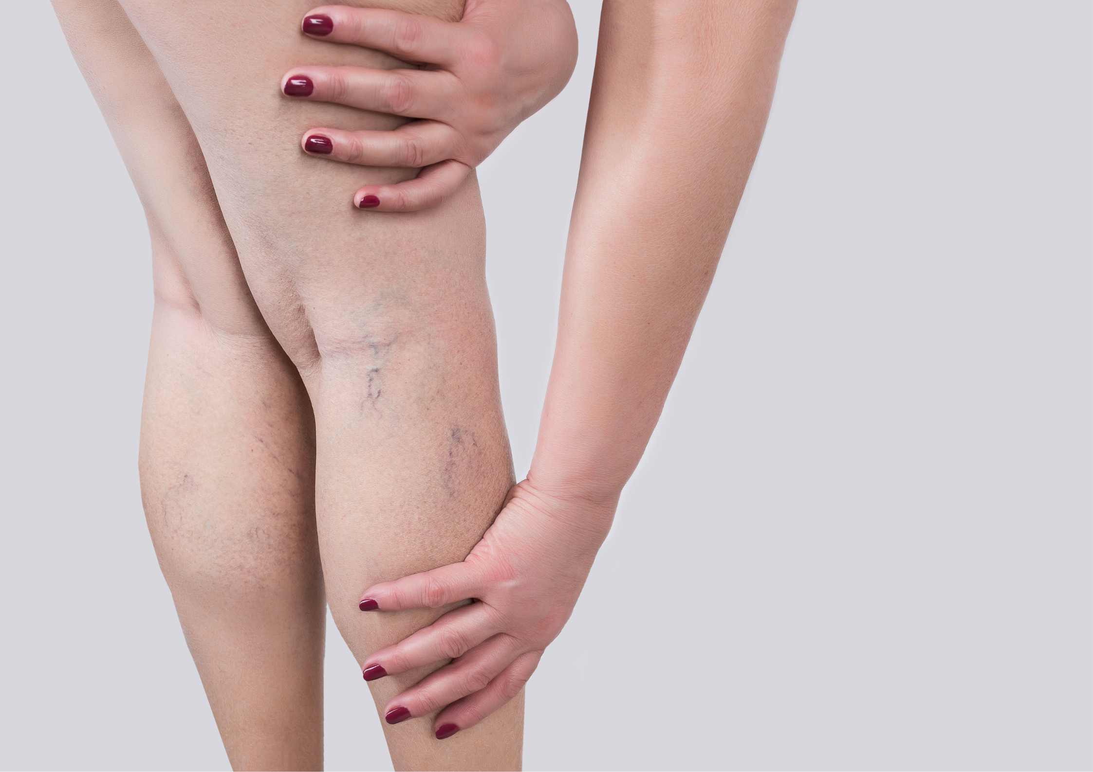 Photo - 1 - Varicose Veins in Hurst: Expert Care at Your Doorstep