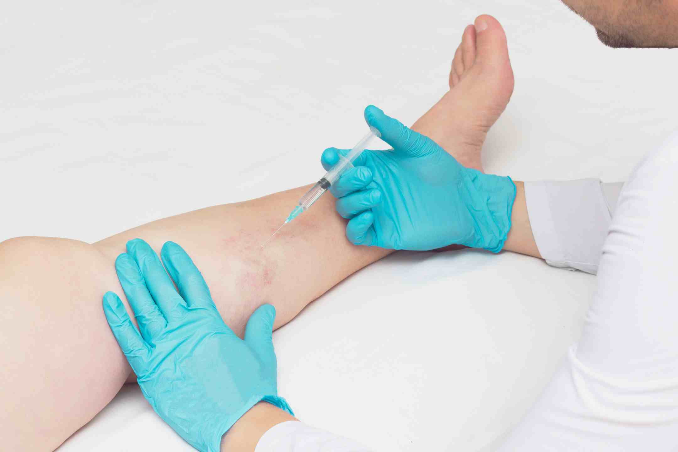 Photo - 1 - Why Are My Veins Blue?