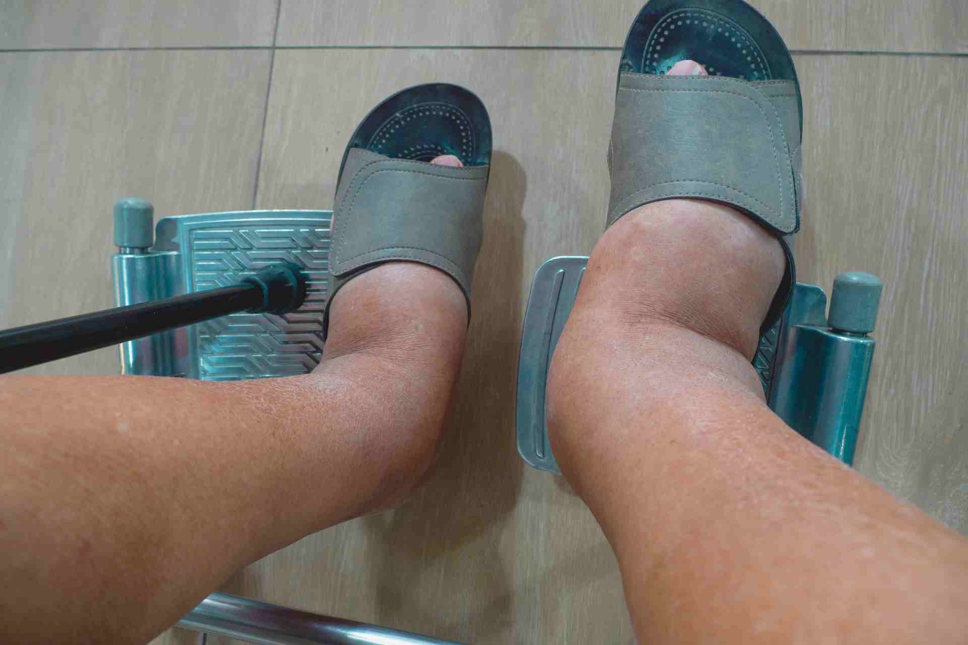 Photo - 0 - What Is Heat Edema?