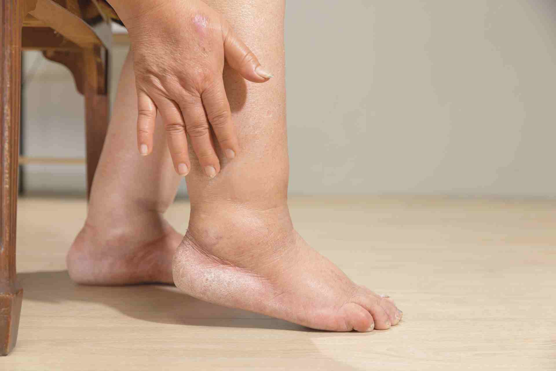Photo - 0 - What Is Heat Edema?