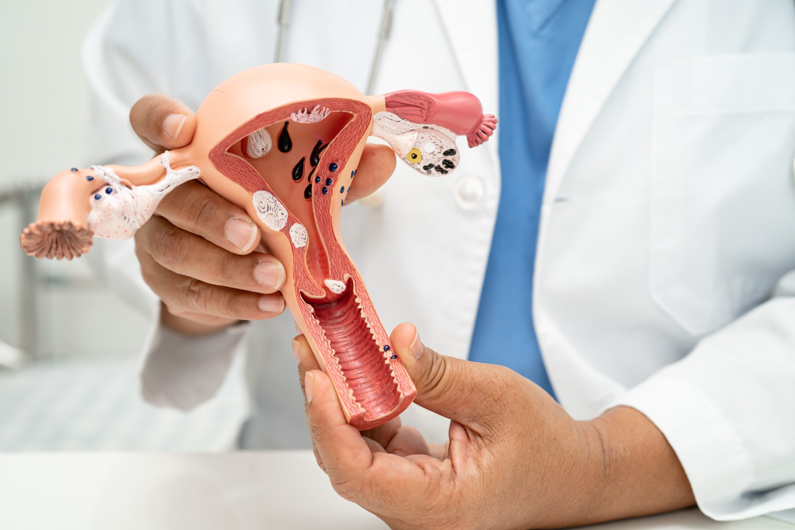 Photo - 0 - Uterine Fibroid Embolization